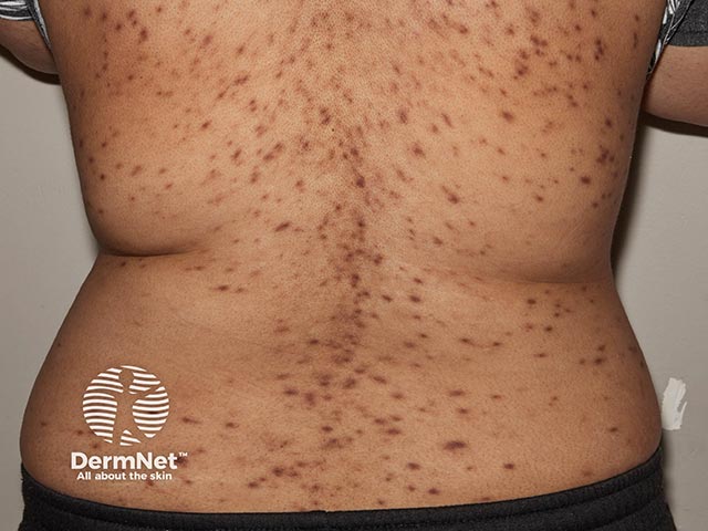 Multiple pigmented papules over the trunk - biopsy showed primary cutaneous plasmacytosis