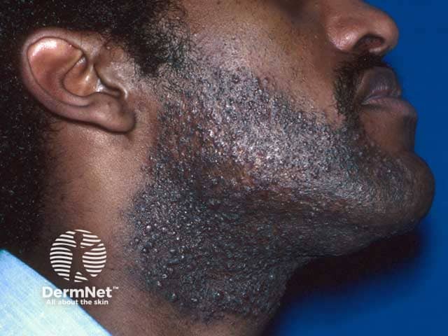 Rounded pigmented papules in the beard area in pseudofolliculitis barbae