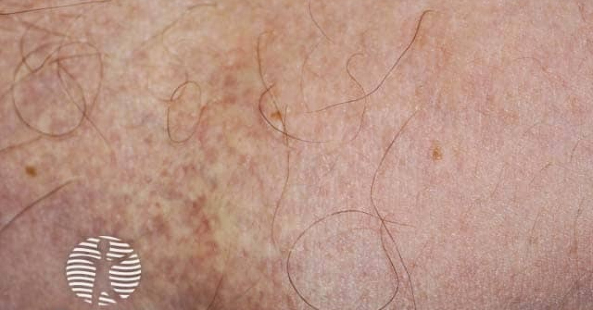 Pseudoxanthoma elasticum image