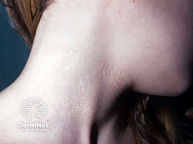 Yellow papules of PXE on the neck