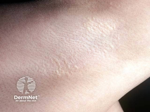 Linear cream yellow papules of PXE in the axilla