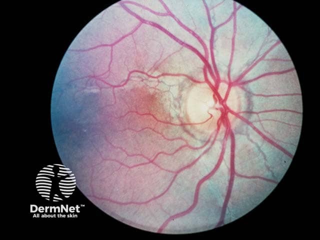 An angioid streak extending from the fundus at 5 o'clock