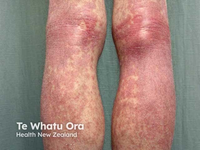 Psoriasis in HIV infection