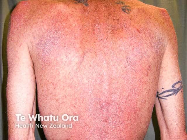 Extensive superficial psoriasis in HIV infection