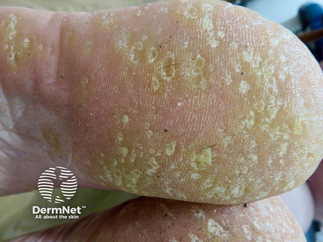 Multiple warty excrescences on the sole in hereditary punctate keratoderma