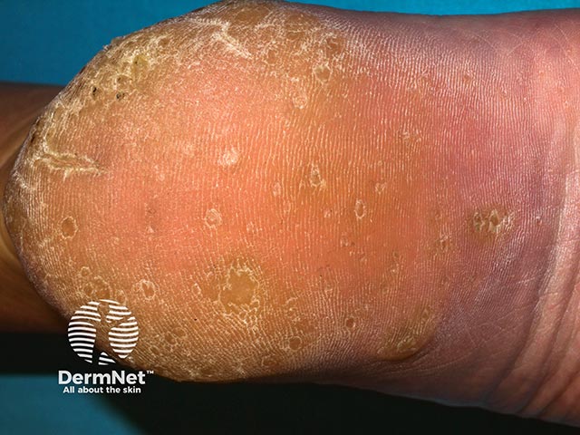 Multiple warty excrescences on the sole in hereditary punctate keratoderma