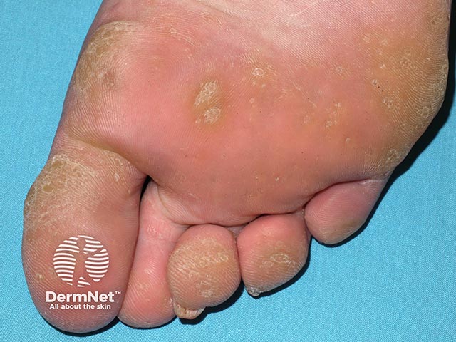 Multiple warty excrescences on the sole in hereditary punctate keratoderma