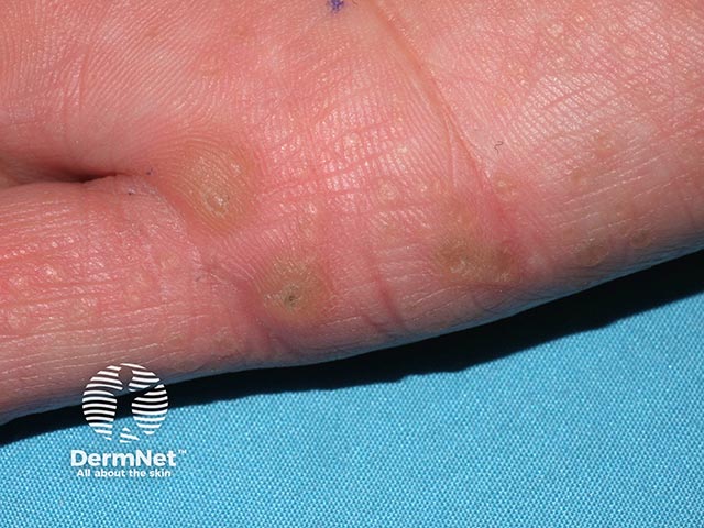 Multiple excrescences on the palm in hereditary punctate keratoderma