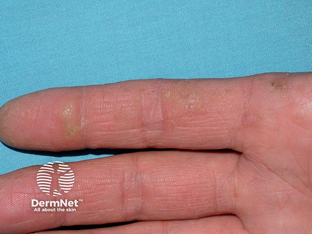 Multiple excrescences on the palm in hereditary punctate keratoderma