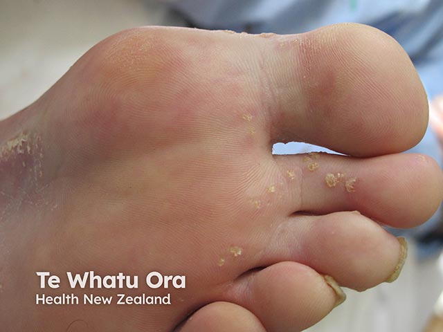 Multiple excrescences on the foot in hereditary punctate keratoderma