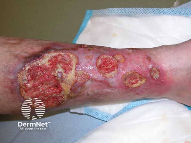 Multiple ulcers on the shin - the superior edge of the proximal ulcer showing the characterisitc purple edge