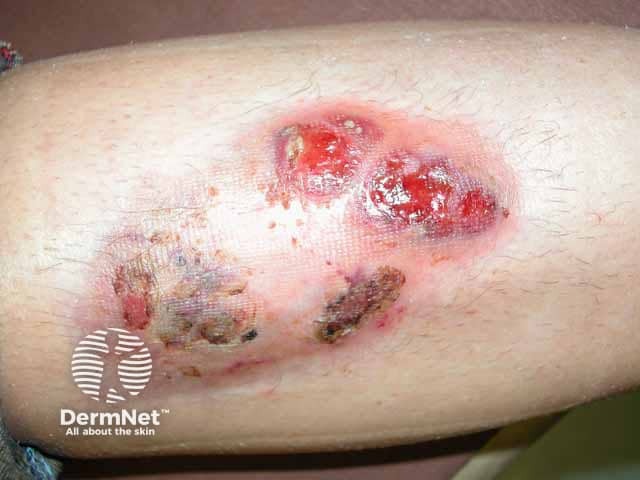 Ulceration, pustulation and the violaceos edge of pyoderma gangrenosum on the shin associated with ulcerative colitis