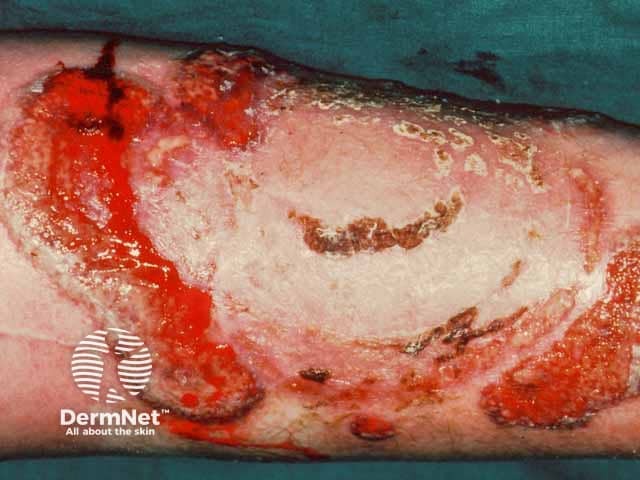 Bullous pyoderma gangrenosum with underlying ulcerative colitis