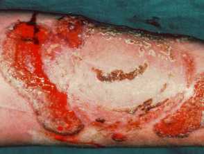 Pyoderma gangrenosum