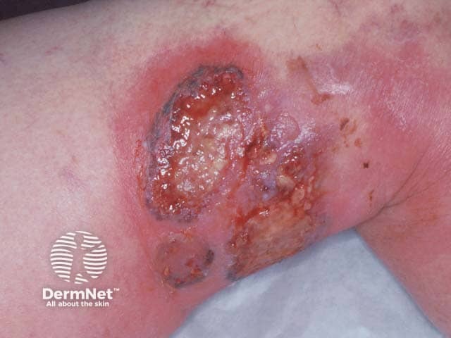 The erythematous and violaceous border typical of pyoderma gangrenosum above the knee