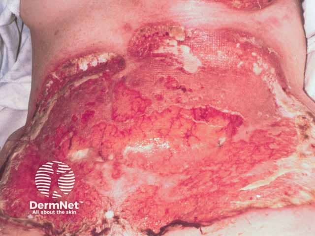 Severe pathergic pyoderma gangrenosum after breast cancer reconstructive surgery (TRAM procedure)