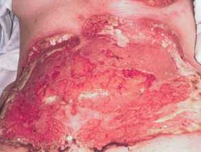 Pyoderma gangrenosum