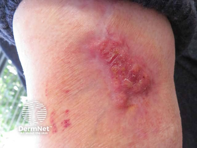 Healed pyoderma gangrenosum after intralesional steroid injection (5 months ago)