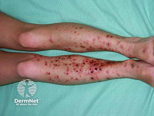 Multiple pustules and ulcers due to pyoderma gangrenosum