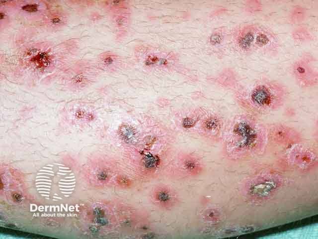 Ulcers, erosions and crusts due to pyoderma gangrenosum on the legs