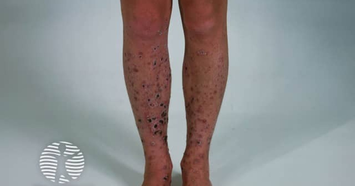 Pyoderma gangrenosum image