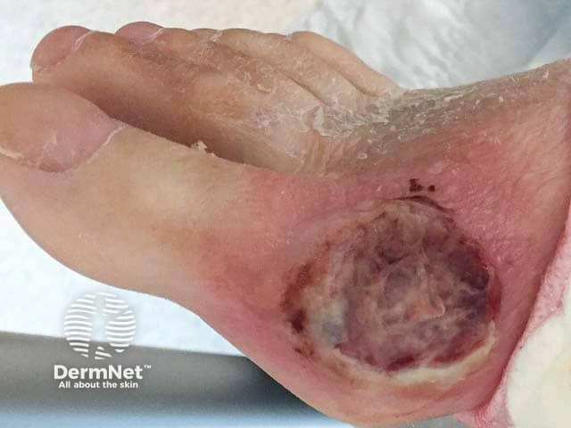 Pyoderma gangrenosum - similar lesions were present on the hand and leg