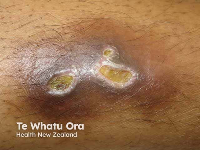 Healing ulcers due to pyoderma gangrenosum on the shin