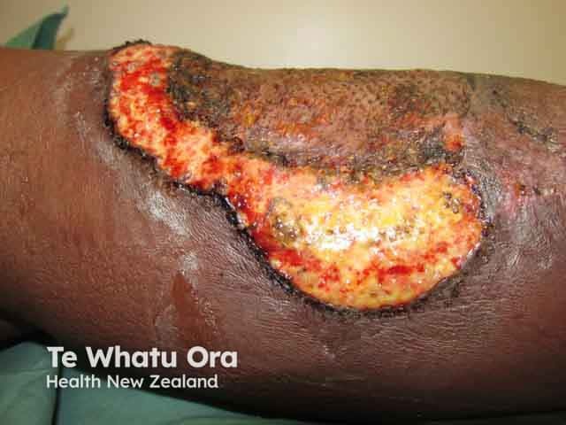 Pyoderma gangrenosum on the leg