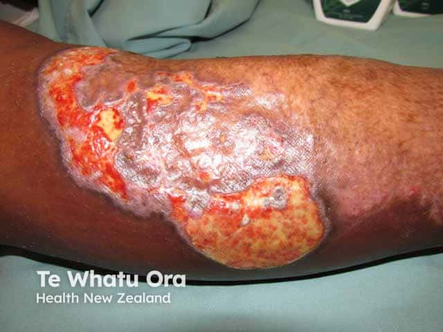 Healing shin pyoderma gangrenosum