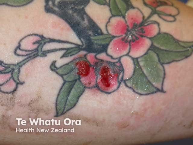 Pyoderma gangrenosum in a tattoo with underlying inflammatroy bowel disease