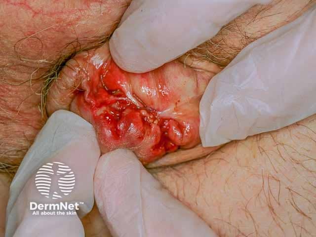 Ulceration on the penis due to pyoderma gangrenosum