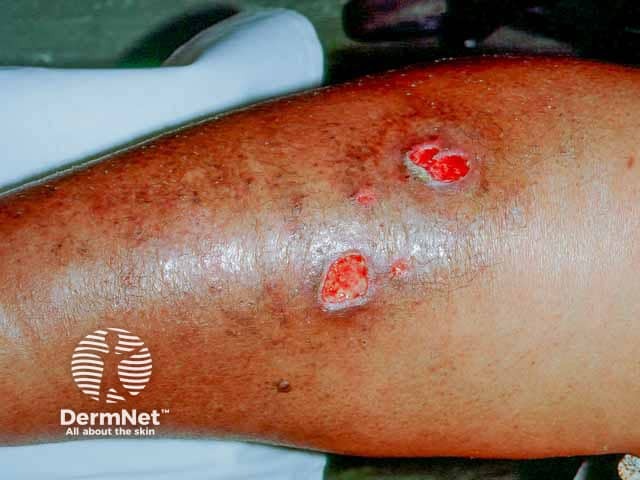 Chronic indolent shin ulcers due to pyoderma gangrenosum