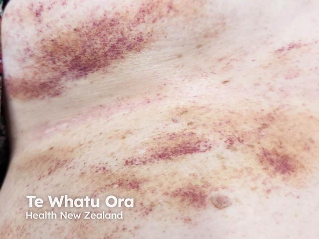 Painful purpuric areas in Gardner Diamond syndrome