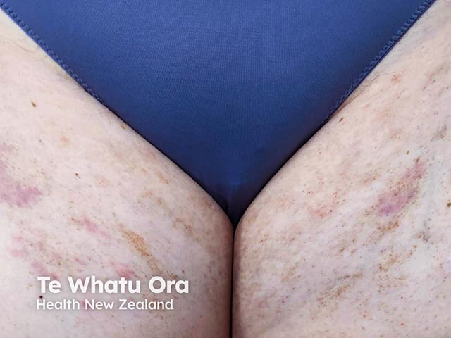 Painful purpuric areas in Gardner Diamond syndrome