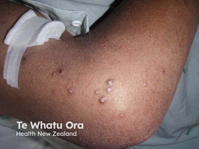 Reactive perforating collagenosis in a diabetic