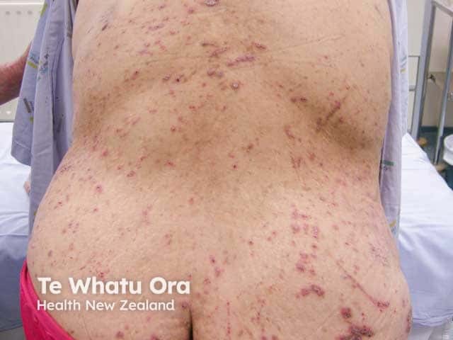 Reactive perforating collagenosis in a diabetic with renal failure