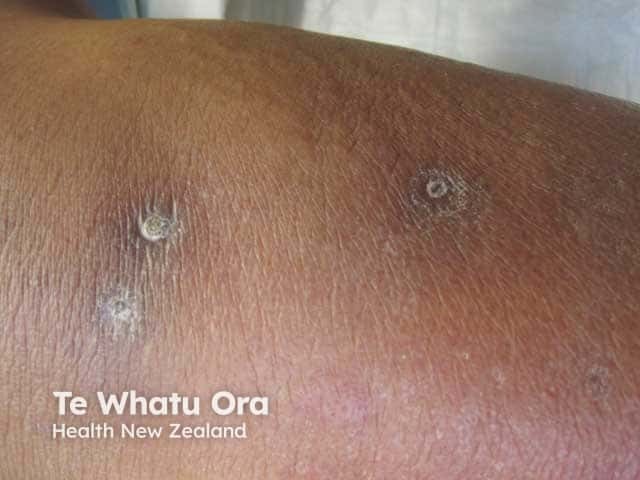 Reactive perforating collagenosis: nodules with keratotic plug