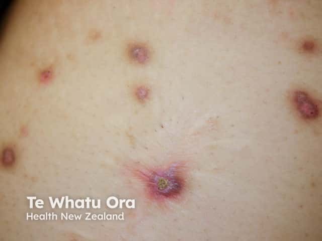 Reactive perforating collagenosis in a diabetic