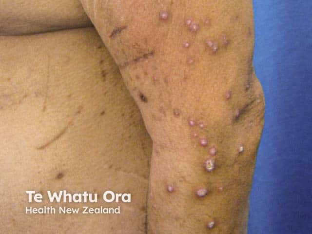 Reactive perforating collagenosis in a diabetic with renal failure