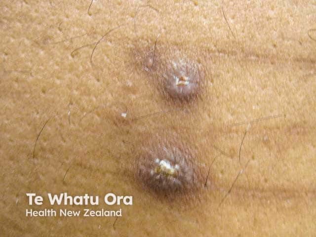 Reactive perforating collagenosis: nodules with keratotic plug
