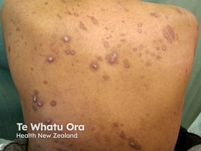 Reactive perforating collagenosis in a diabetic with renal failure
