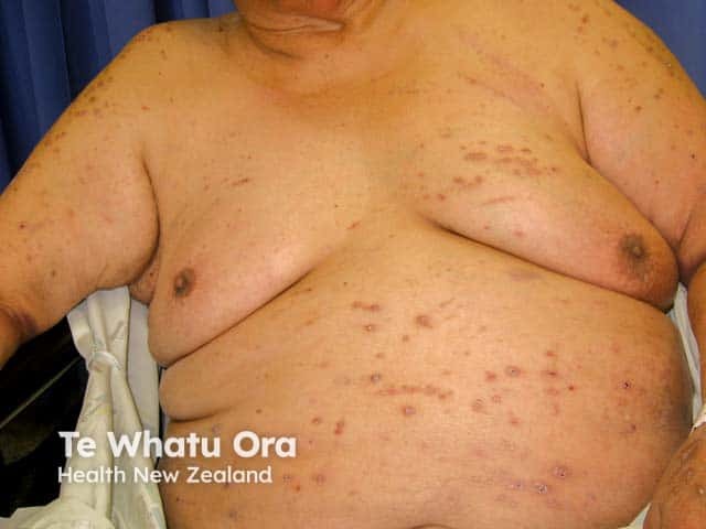 Reactive perforating collagenosis: renal failure