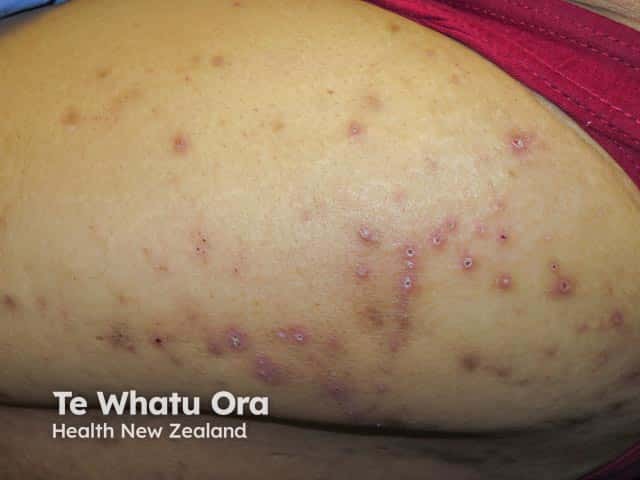 Reactive perforating collagenosis in a diabetic with renal fialure