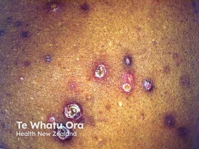 Reactive perforating collagenosis: papules and nodules with keratotic plug