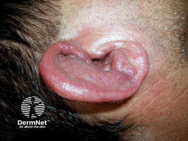 A swollen red inflammed pinna due to polychondritis - both ears were affected. Note sparing of the non-cartilaginous lobe
