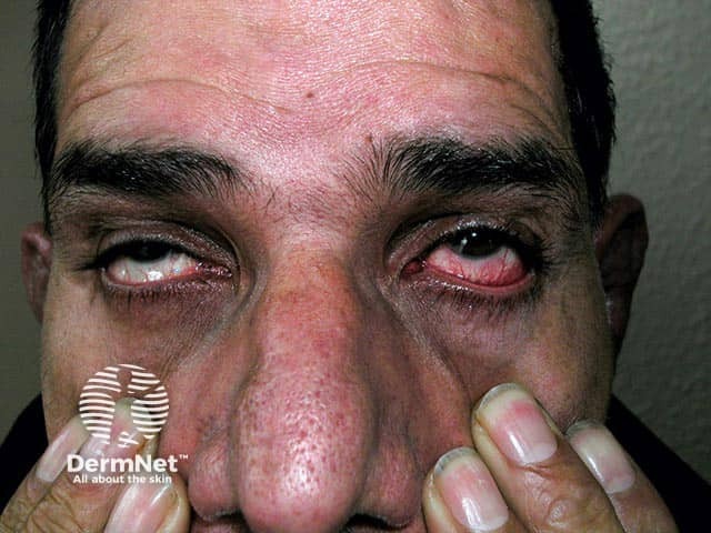 Red eyes (which can be due to scleritis, episcleritis, conjunctivitis, and iritis) seen as part of the presentation of relapsing polychondritis