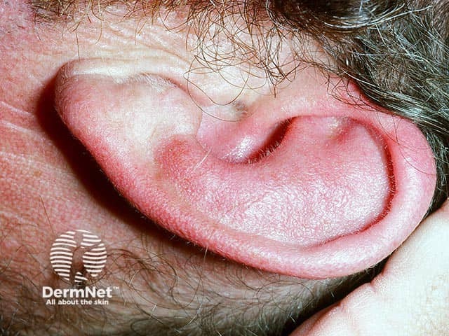 Swelling and erythema of the upper cartilaginous part of the helix with sparing of the non-cartilaginous lobe