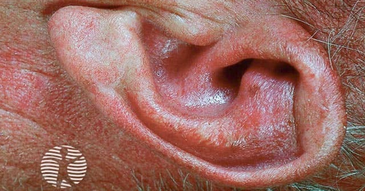 Relapsing polychondritis image