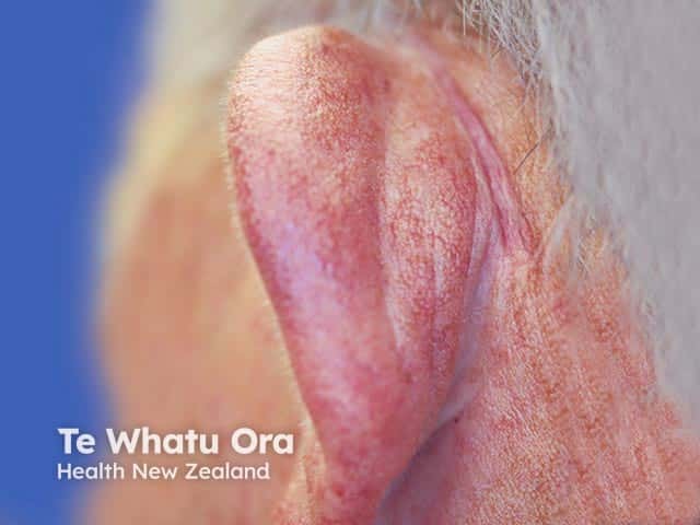 Swelling of the helix in relapsing polychondritis followed by floppiness of the ear