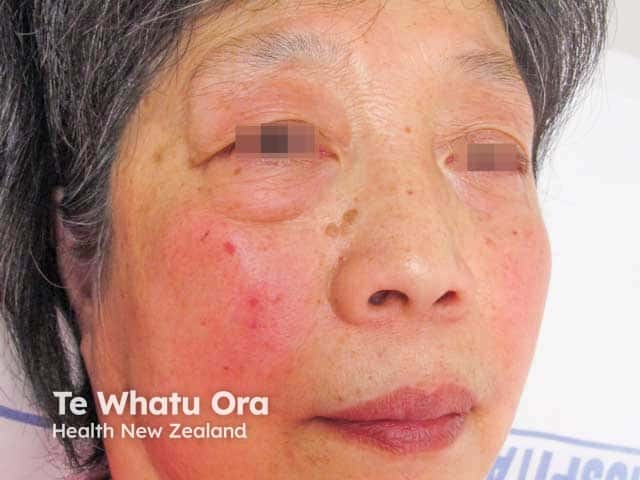 Erythematotelangiectatic and papular rosacea with ocular rosacea